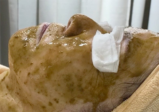 ハーブピーリング